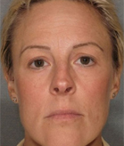 Patient # 72995 After Photo # 2
